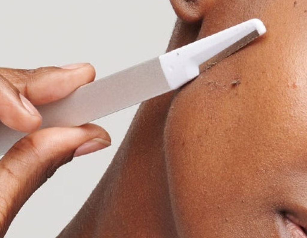 dermaplaning london