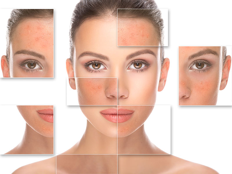 PRX-T Medical Grade Peel in Islington & Angel, London